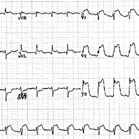 e ECG showing anterior wall MI [ST elevation in leads V1-4] with... | Download Scientific Diagram