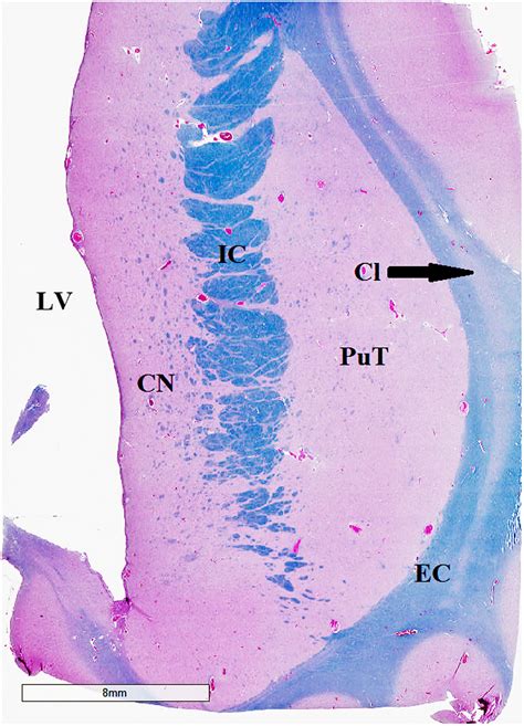 Irresti: Corticobasal Degeneration Criteria