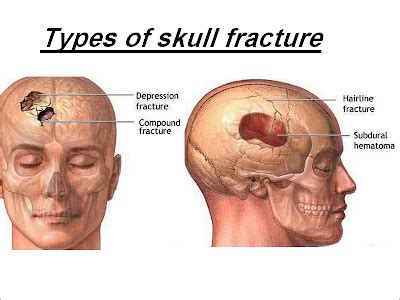 Skull Fracture Types Symptoms And Long Term Effects | My XXX Hot Girl