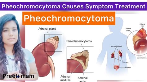 Pheochromocytoma Cause Symptoms Diagnostic Evaluation Treatment in Hindi | What is ...