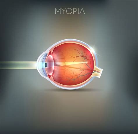 myopic macular degeneration | Macular degeneration, Macular degeneration symptoms, Treatment options