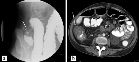 a) Apple core lesion in the ascending colon in double contrast colonic... | Download Scientific ...