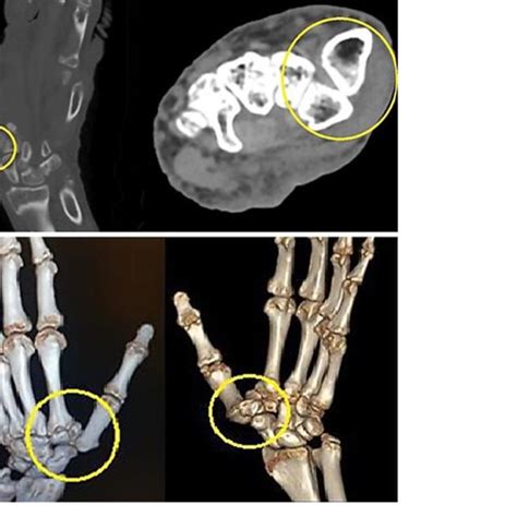 (PDF) Traumatic Dorsoradial Trapezium-Metacarpal Joint Dislocation