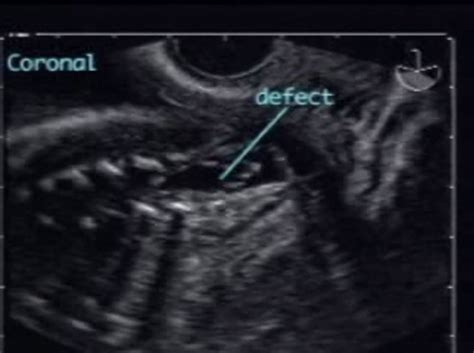 Myelomeningocele – ULTRASOUNDPAEDIA