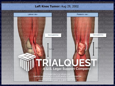 Left Knee Tumor - TrialQuest Inc.