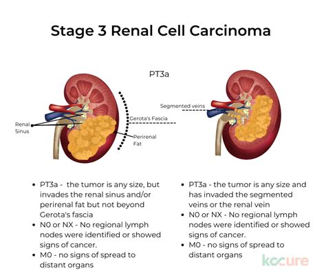 Kidney Cancer Stages | KCCure | kidney cancer | diagnosis | stages