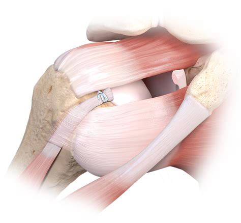 Arthrex - Loop 'N' Tack™ Biceps Tenodesis Technique