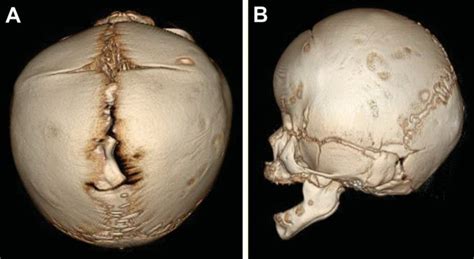 Craniosynostosis - UF Health