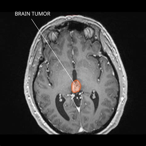 Pineal Region Tumors - National Cancer Institute