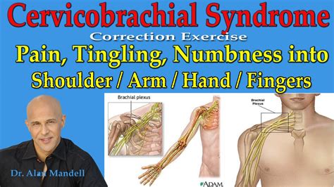 Cervicobrachial Syndrome (Corrective Exercise) Pain, Burning into Shoulder, Arm, Hand - Dr ...