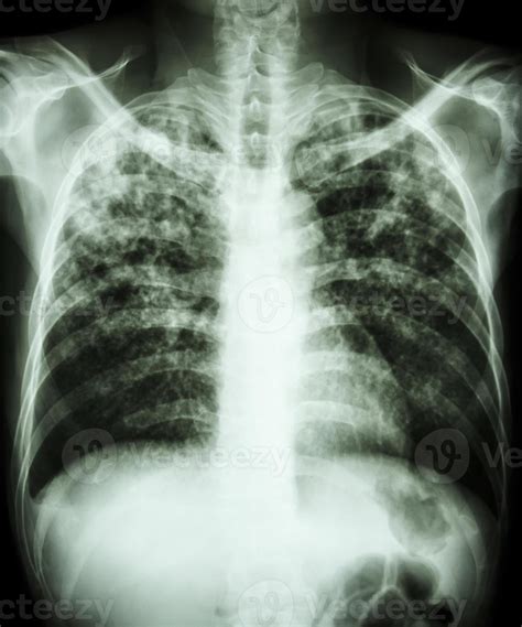 Tuberculosis Rx Torax