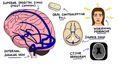 Cerebral Venous Sinus Thrombosis (CVST) | With Dural Venous Sinuses ...