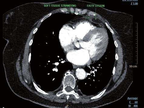 -CT angiography showing fatty lesion -pericardial fat necrosis (see... | Download Scientific Diagram