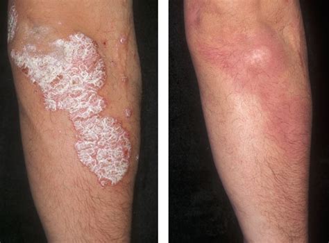 What is psoriasis and why should I care about it? | Crutchfield Dermatology