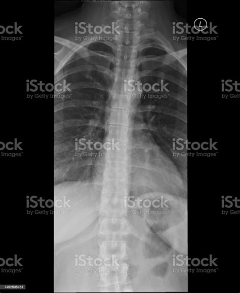 Thoracic Spine Xray Anteroposterior View Stock Photo - Download Image ...