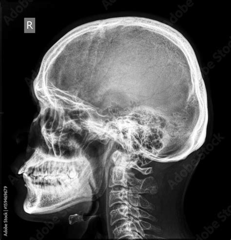 Skull X-ray of normal subject Stock Photo | Adobe Stock