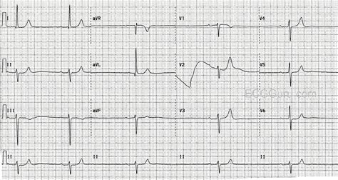 Sinus Bradycardia With First-Degree AV Block and Left Anterior Fascicular Block | ECG Guru ...