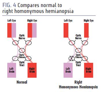 Lesson: WHY YOU DON'T WANT HOMONYMOUS HEMIANOPSIA AND WHAT YOU CAN DO FOR IT