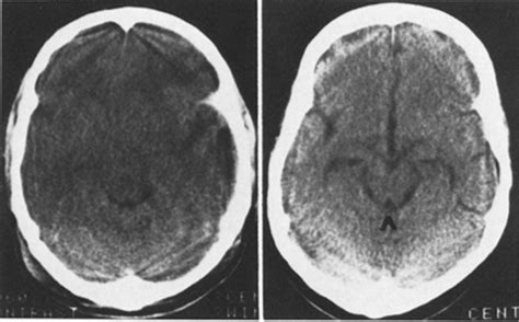 Absent or compressed basal cisterns on first CT scan: ominous ...