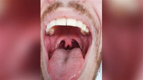 Photo of Man's 'Double' Uvula Goes Viral - ABC News