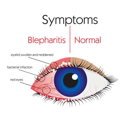 Blepharitis: Symptoms and Treatment | Fort Lauderdale Eye Institute