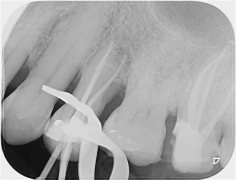 Root canal treatment gallery before & after photos | London Dentist