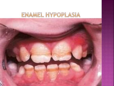 Enamel hypoplasia ppt