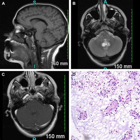 Posterior Fossa Tumors in Adult Patients | Radiology Key