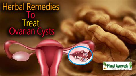 Top 3 Herbal Remedies to Treat Ovarian cysts | 247HealthBlog