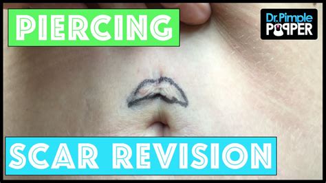 Navel Piercing Scar Revision