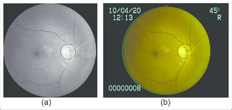 Extracted optic disc: (a) results obtained by panning and zooming ...