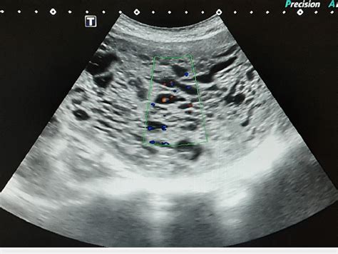 Color Doppler ultrasonography image demonstrating no vascularity within ...