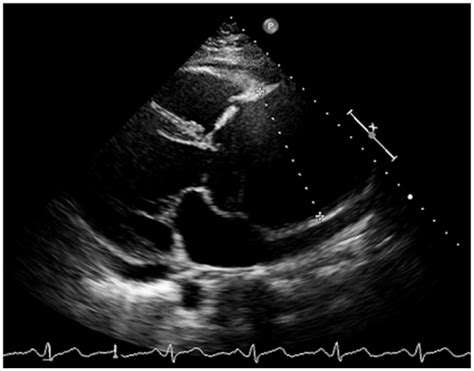 Thoracic aortic aneurysm - Maya J Salameh, James H Black, Elizabeth V ...