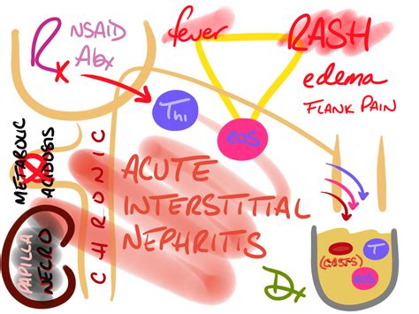 Acute Interstitial Nephritis – The Other Library.