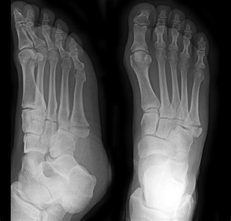 Pseudo Jones Fracture