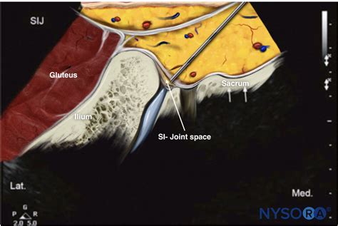 Ultrasound-Guided Sacroiliac Joint Injection - NYSORA