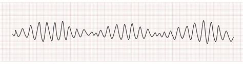 EKG Monitor Showing Polymorphic Ventricular tachycardia or VT Torsades de pointes 20203442 ...