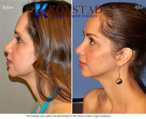 Facial Fat Transfer Before & After Gallery | Dr. Kolstad - San Diego ...