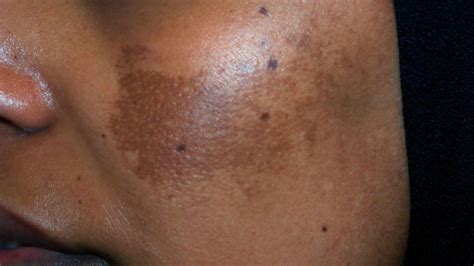 Melasma in African-American Skin: Causes and Treatment Approaches - Black Dermatologists Directory