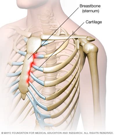 My so-called CIVILIAN LIFE: Costochondritis 1, Wongstar 0.