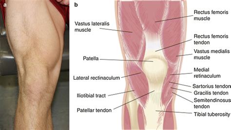 Quadriceps Tendon Ruptures | SpringerLink