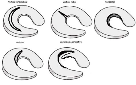 Complex Tear Of Medial Meniscus - All You Need Infos