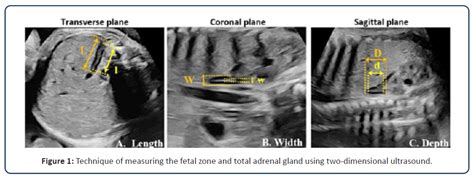 Two-Dimensional Ultrasound Fetal Adrenal Gland Enlargement to Predict ...