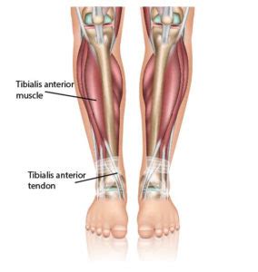 Ankle Tendonitis | Anterior Tibial Tendonitis