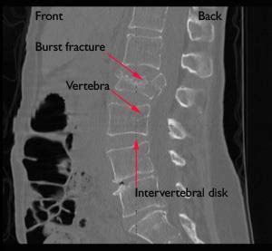 Fractures of the Thoracic and Lumbar Spine - OrthoInfo - AAOS