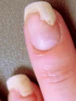 fingernail lifted from nail bed - pictures, photos