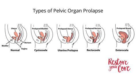 PELVIC FLOOR SPECIALIST | FINDING HELP TO HEAL YOUR PELVIS - RYC®