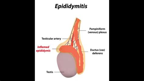 Epididymitis | Instagram ideas photography, Plexus products, Tutorial