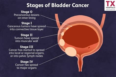 Bladder Cancer Risk Factors, and Treatment Options | TX Hospitals