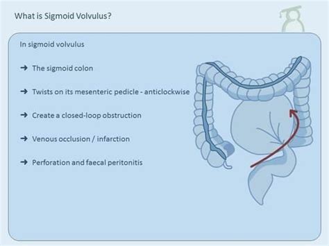 Sigmoid volvulus Nurse Jackie, Health Info, Surgery, Nursing, Knowledge ...